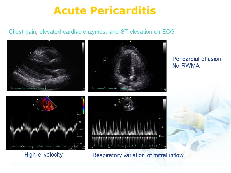 Acute Pericarditis Pericardial effusion No RWMA Chest pain, elevated cardiac enzymes, and ST elevation